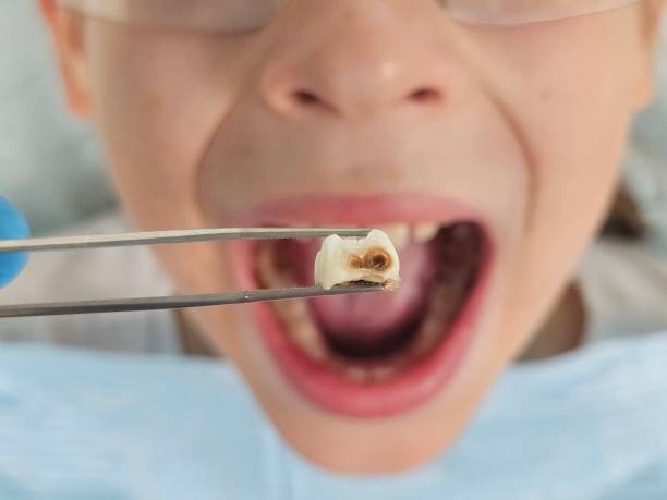 Best Emergency Tooth Extraction in Kodi Station, AK